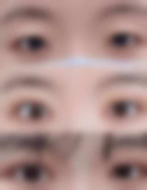双眼皮线漏出来了怎么办？别慌！医生教你正确处理线头外露与鼓包问题