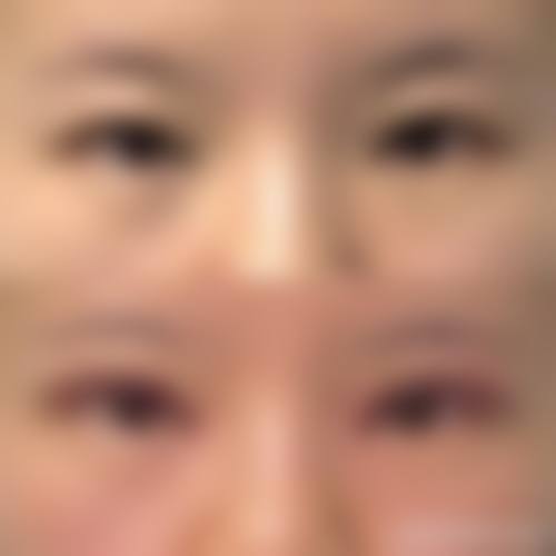 八、埋线双眼皮风险或注意事项