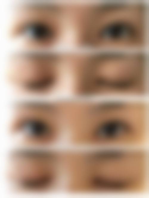 二、割双眼皮多一条线如何处理