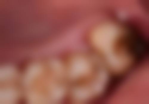 拓展延伸:深圳種牙vs港澳本地種牙,邊個更抵?