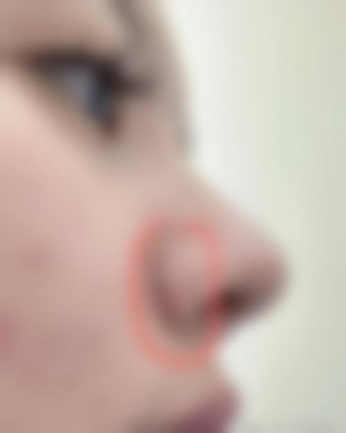 三、如何降低疤痕体质做鼻子留疤的风险