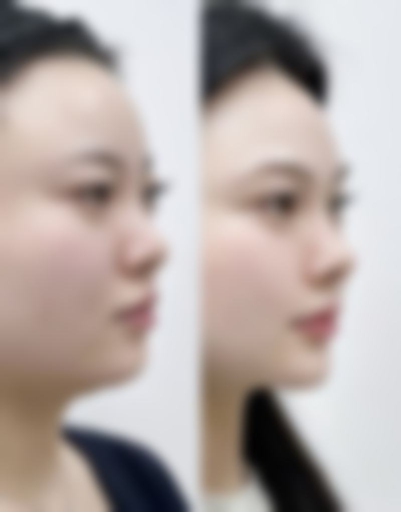 韓國4月31日會唔會推銷？2026最新價目表+金載勳醫生鼻修復案例大揭秘！
