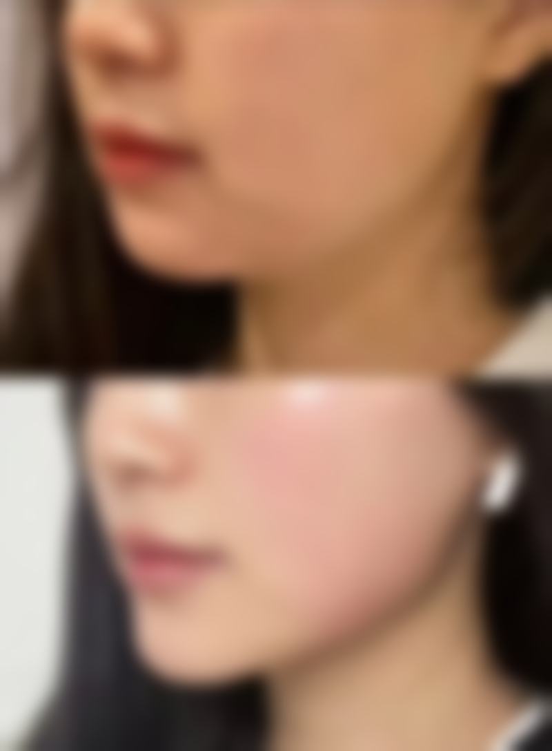 韓國雙眼皮恢復日記ptt 診所揀選要點:香港邊間好?澳門邊度穩?