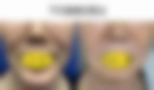 五、详解从 6800 元到 10800 元的鼻部奥美定移除手术收费逻辑