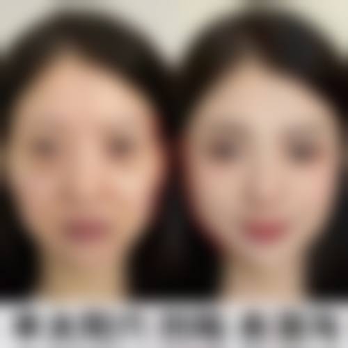 五、丰太阳穴方法选择建议