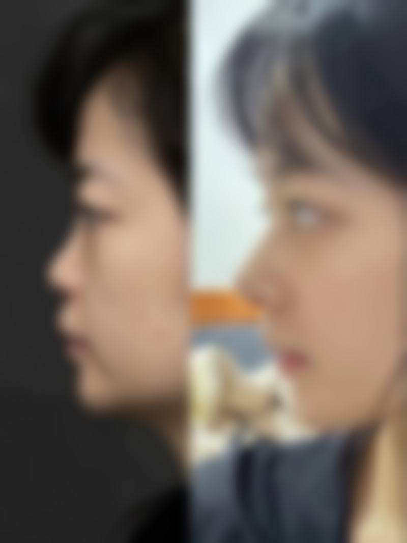二、为何奥美定鼻子取出价格差异这么大