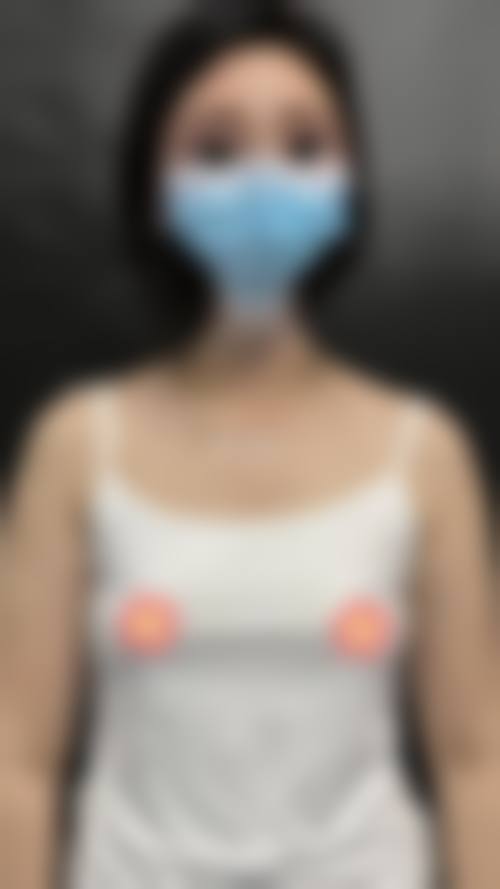 韓國自體脂肪隆胸存活率高嗎 vs 假體隆胸:邊個更適合港澳姊妹