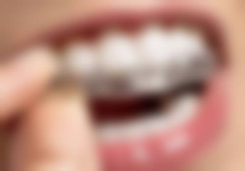 九、牙齿矫正的注意事项