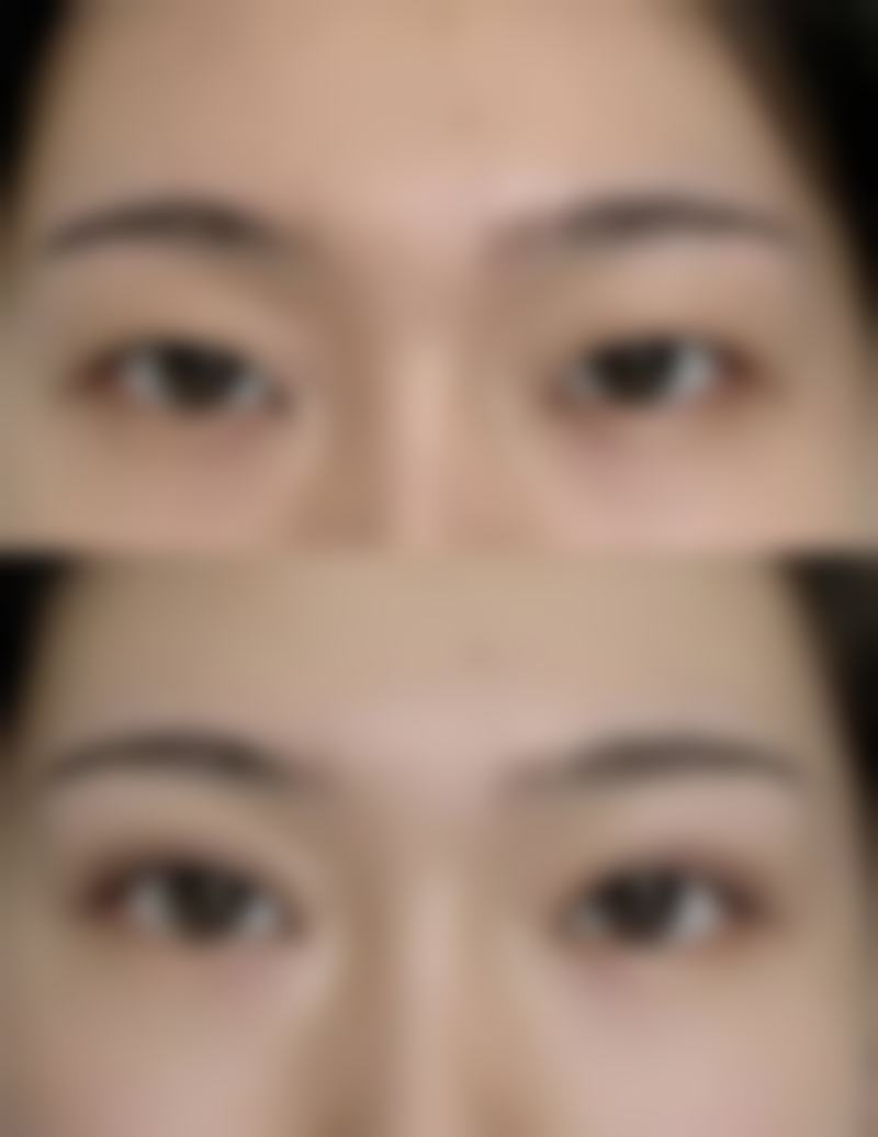 六、去眼袋安心吗 / 有哪些风险