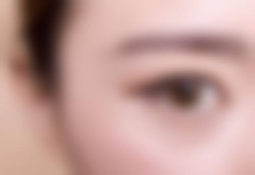 四、眶隔脂肪释放术,解决眼袋泪沟双重难题