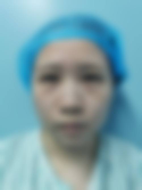 怎么能除去眼袋黑眼圈？2026新微创激光技术3800-6800元，7天消袋+三甲主任亲诊超放心！