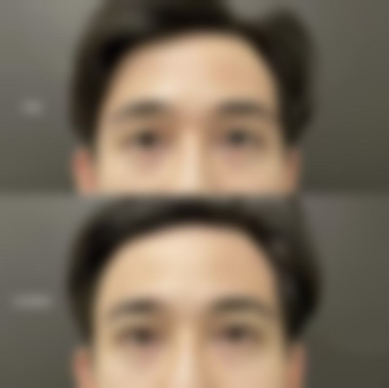 三、外切法祛眼袋,重塑眼部年轻态