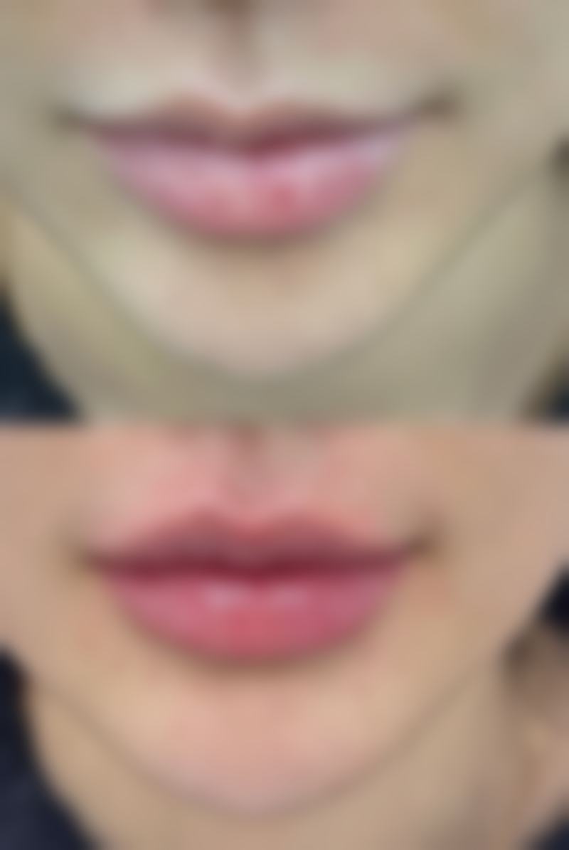 韓國術後幾天可以洗頭 適合邊類人群?返工媽咪必睇