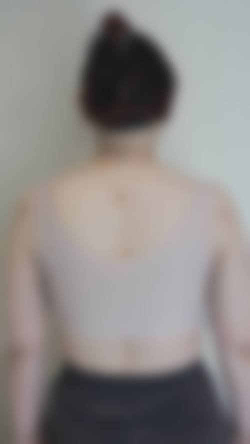 三、吸脂面积大小,对消肿时间有何影响?