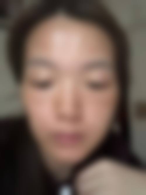 十、纾昕助理医生相关科普内容推荐——激光祛斑介绍