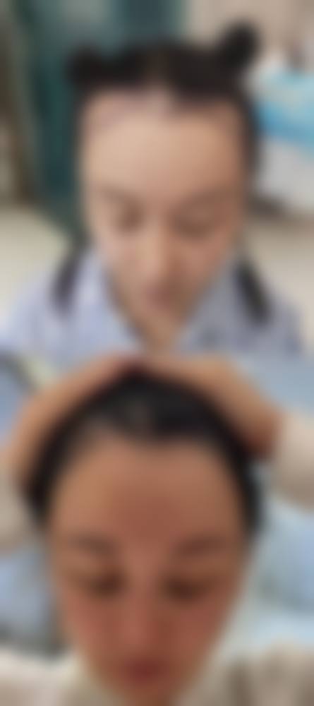 韓國植髮會唔會甩返 術前術後避坑指南