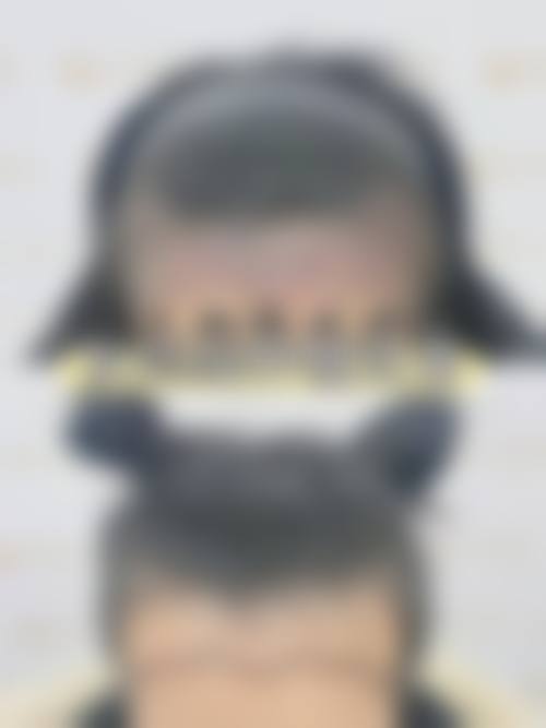 韓國植髮會唔會甩返 適合邊類人群?
