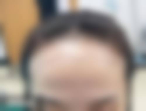 韓國植髮會唔會甩返 診所揀選要點