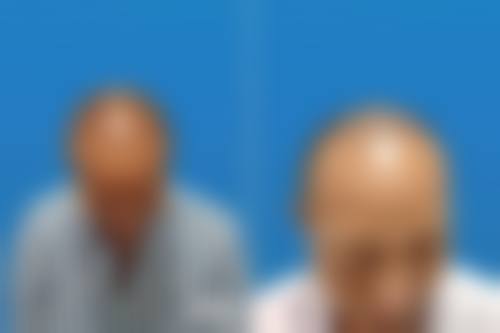 韓國M字額植髮推薦2026：5間出名醫院最新價格/費用大公開，邊間好？