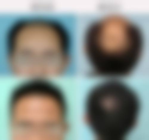 韩国moart毛发移植地理位置便于到院。