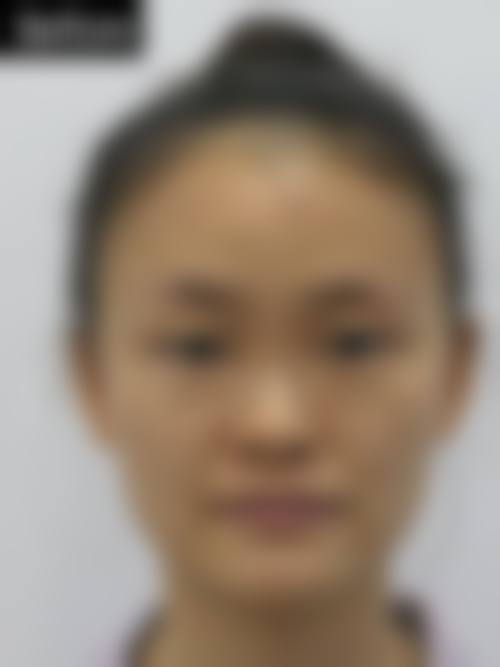 二、膨体加耳软骨隆鼻的维持时间