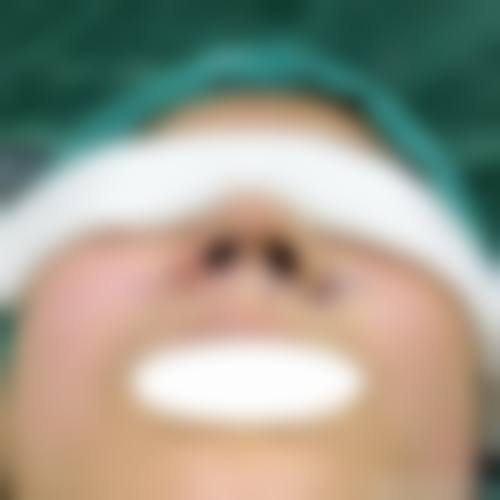 六、膨体加耳软骨隆鼻的风险与后遗症