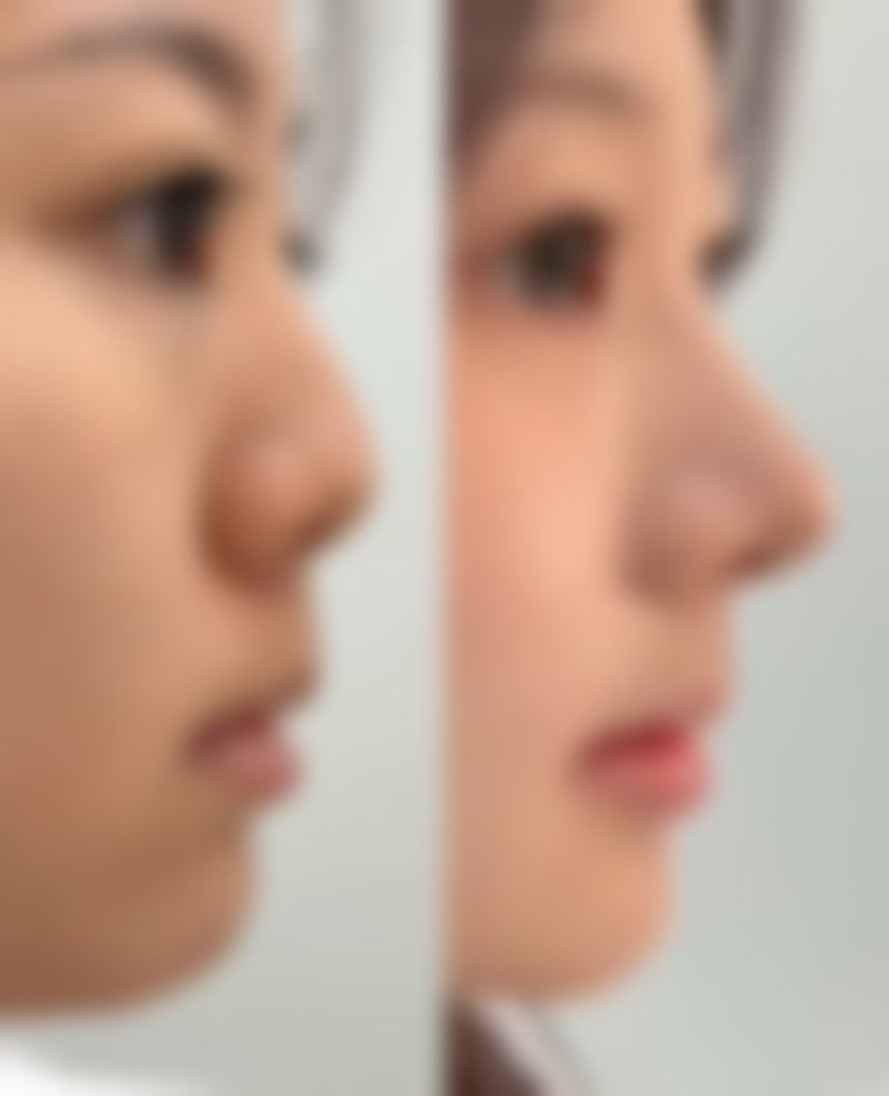五、膨体加耳软骨隆鼻的适合人群