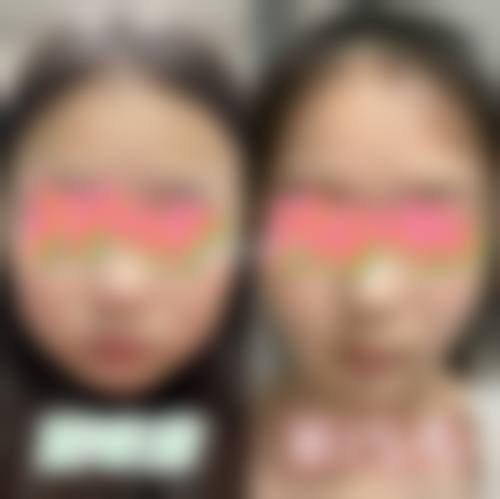 五、瘦脸针适合人群判断