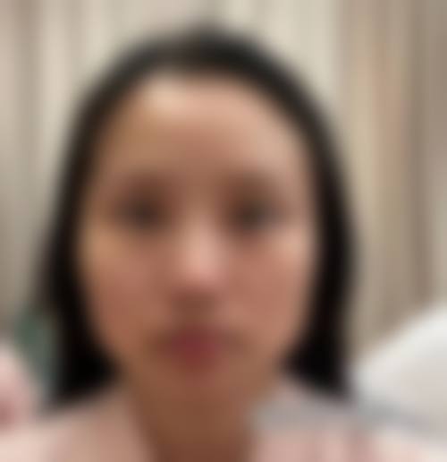 二、1个月咬肌萎缩立现,成效究竟如何