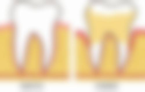 深圳隱適美同時代天使點揀 成效邊個好?牙醫拆解真實实例