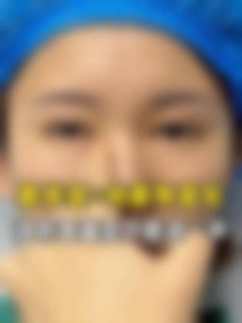 四、全切双眼皮化妆成效如何