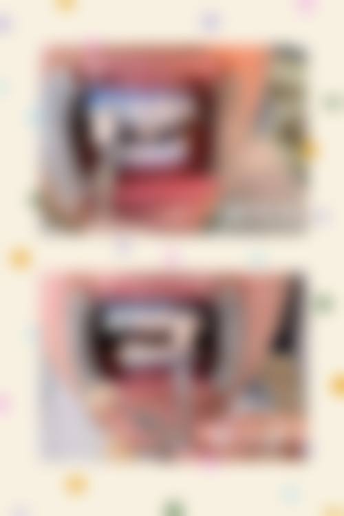 五、儿童地包天矫正注意事项