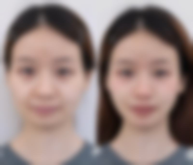 韓國DA整形香港人評價2026｜江南前十強收費/安全嗎？中文服務+輪廓案例大公開！
