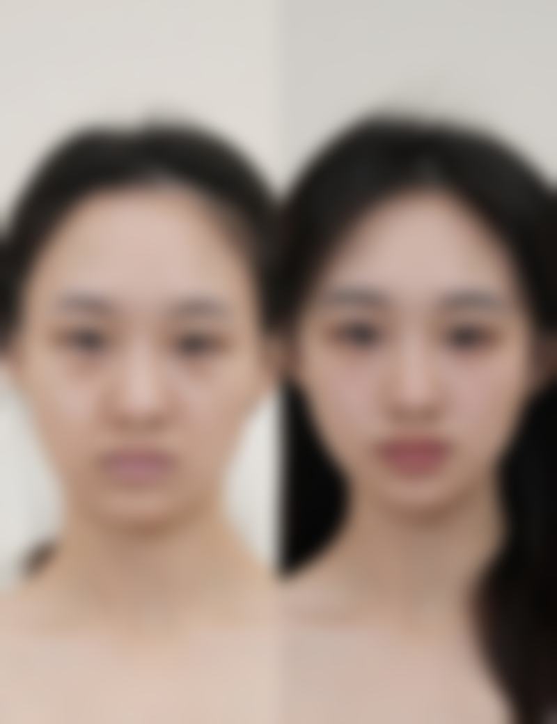 韓國DA整形香港人評價 技術特色：輪廓/鼻修復/雙眼皮实例大公開！