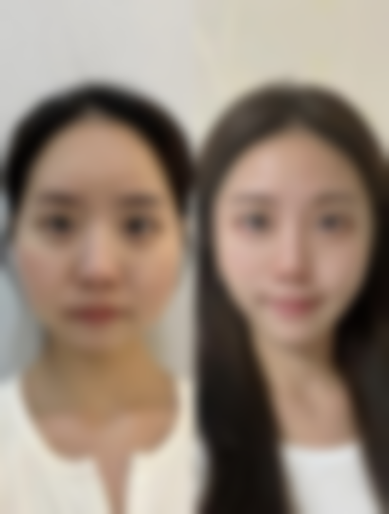 韓國DA整形香港人評價 中文服務+術後管理：香港姊妹唔使驚語言溝通！