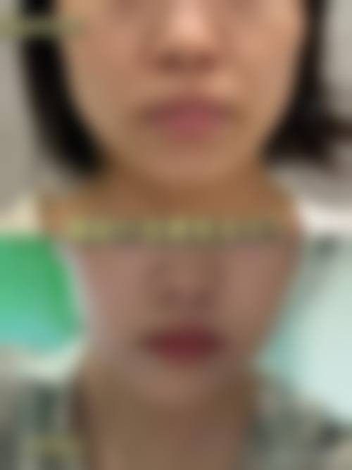 六、瘦脸针价格因素