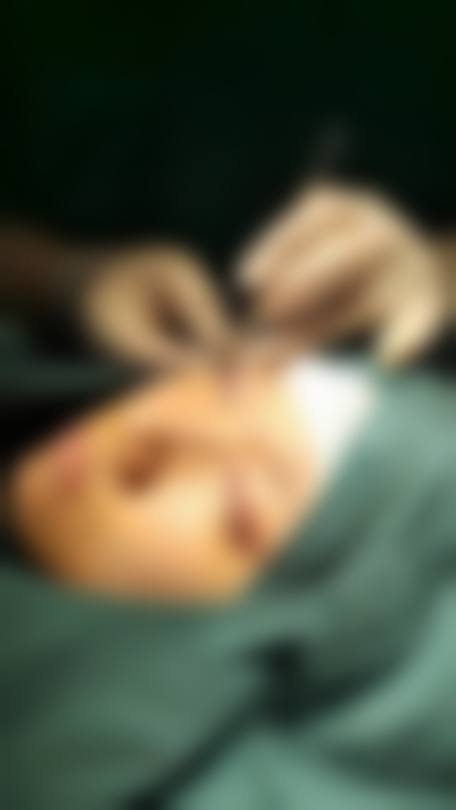五、韩式双眼皮能维持多久