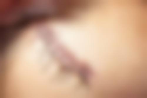 四、微针治疗:刺激皮肤新生,还孩子光洁小脸
