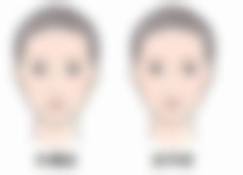舒雅正畸系列价格贵吗