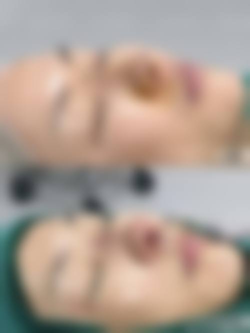 韓國肋骨鼻恢復期多久 項目真相:港澳姊妹更關心3大問題