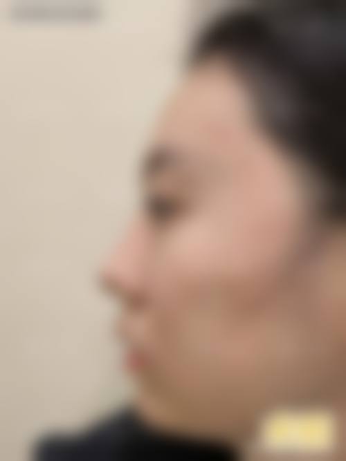 十、李绿水医生擅长项目科普:微整形注射