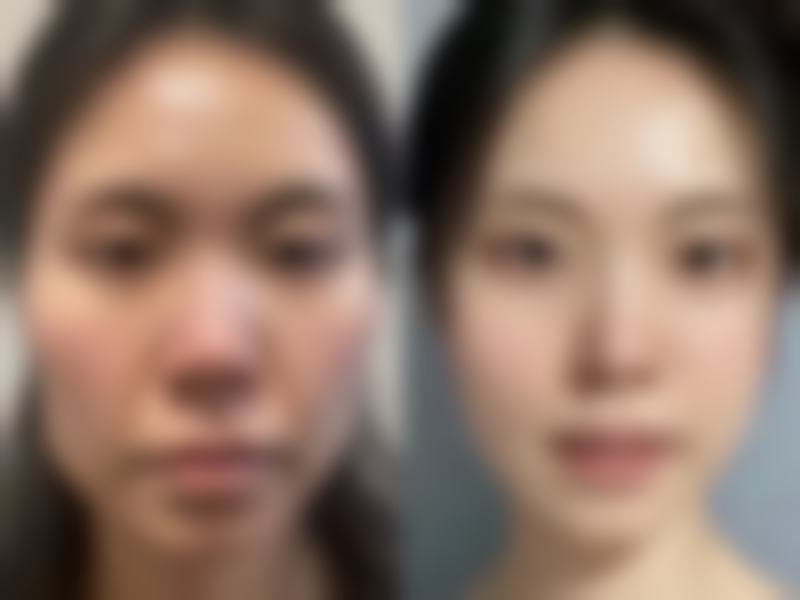 韓國去斑雷射恢復期多久 適合邊類人群？